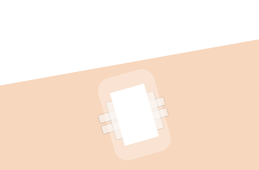 De derde stap van het inbrengproces voor de implanteerbare CGM van het Eversense-systeem.